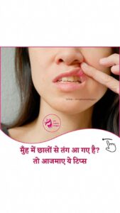 1 दिन कैसे ठीक करें मुँह क़े छाले ये देसी उपचार ( Mouth Ulcer )